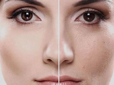 درمان لک و تیرگی های صورت با مزوتراپی پوست